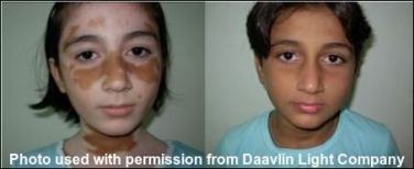 Daavlin Before After Treatment